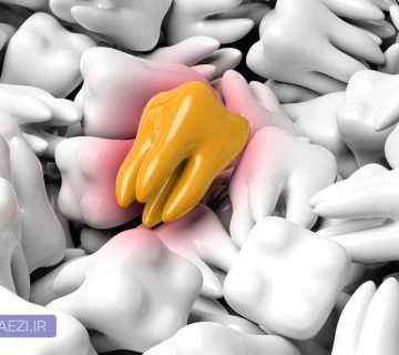 wisdom tooth یا دندان عقل چیست؟چند سالگی رویش می کند و روش های درمان و کشیدن دندان عقل پوسیده و نهفته در تبریز