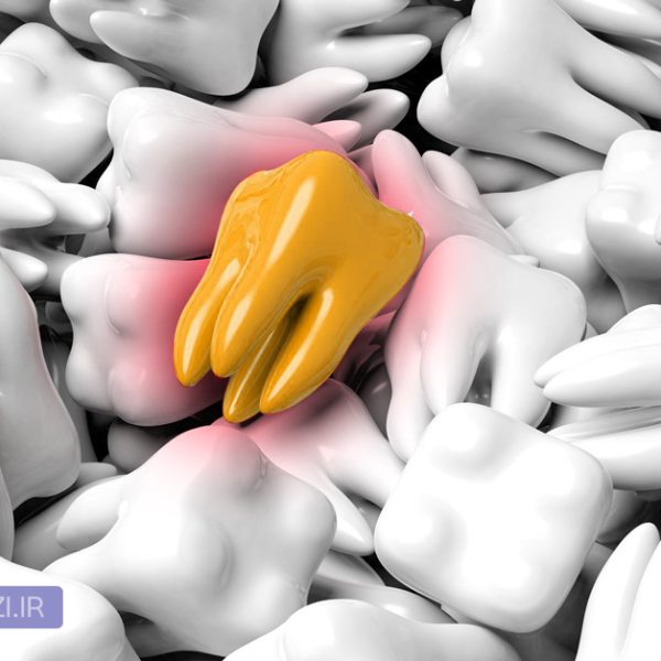 wisdom tooth یا دندان عقل چیست؟چند سالگی رویش می کند و روش های درمان و کشیدن دندان عقل پوسیده و نهفته در تبریز