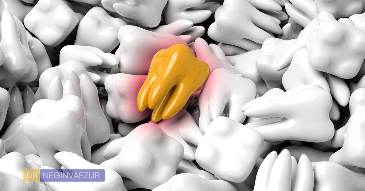 wisdom tooth یا دندان عقل چیست؟چند سالگی رویش می کند و روش های درمان و کشیدن دندان عقل پوسیده و نهفته در تبریز