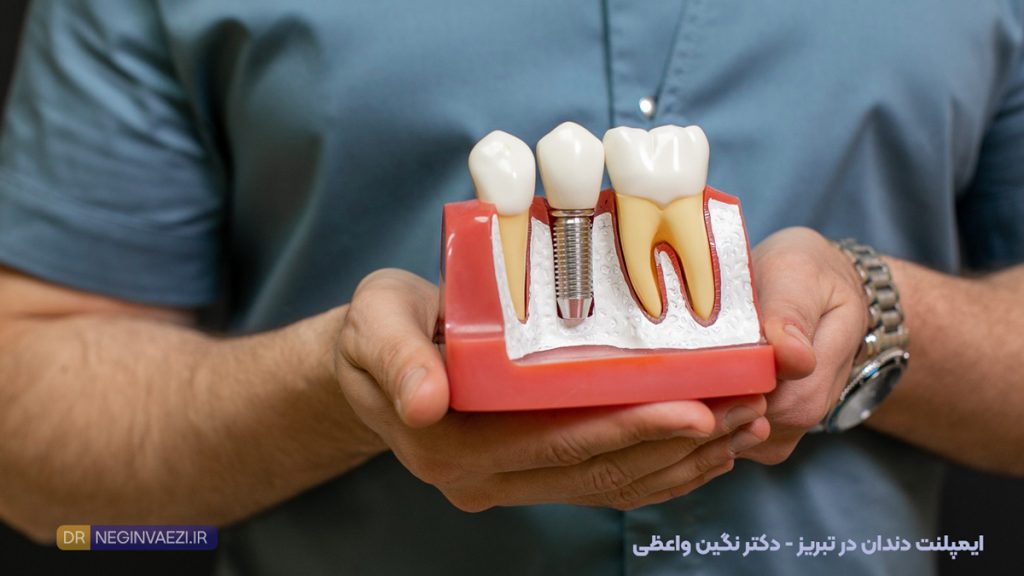 عوامل مؤثر بر قیمت و هزینه نهایی ایمپلنت در تبریز