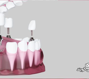 قرار دادن ایمپلنت فوری در حفره دندان کشیده شده با پیوند استخوان اطراف در ولیعصر تبریز