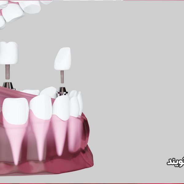 قرار دادن ایمپلنت فوری در حفره دندان کشیده شده با پیوند استخوان اطراف در ولیعصر تبریز