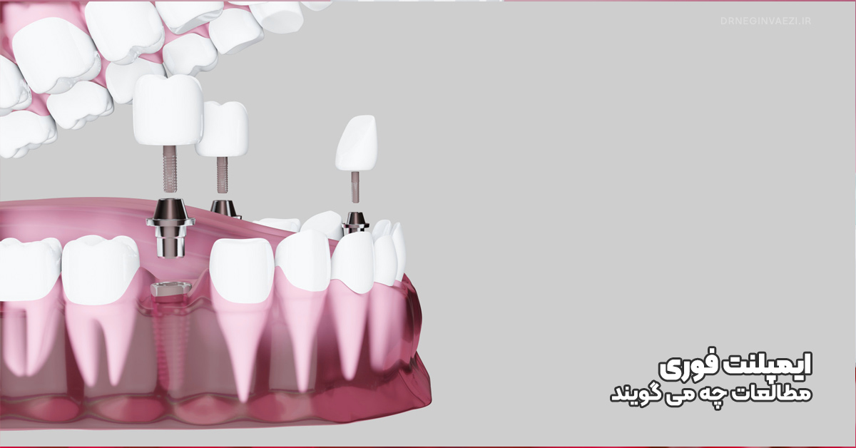 قرار دادن ایمپلنت فوری در حفره دندان کشیده شده با پیوند استخوان اطراف در ولیعصر تبریز