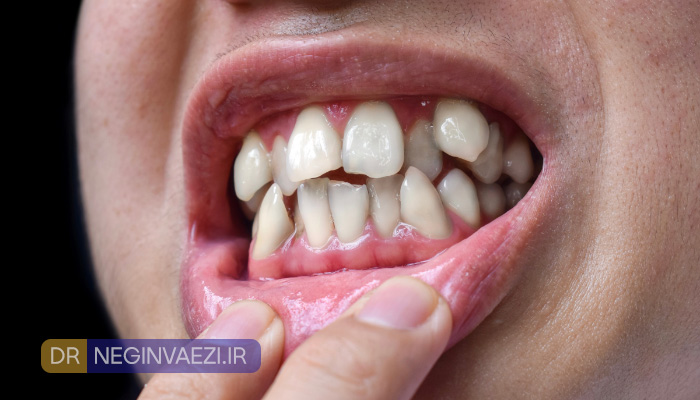 افراد دارای براکسیسم یا دندان قروچه برای ونیر کامپوزیتی نامناسب هستند