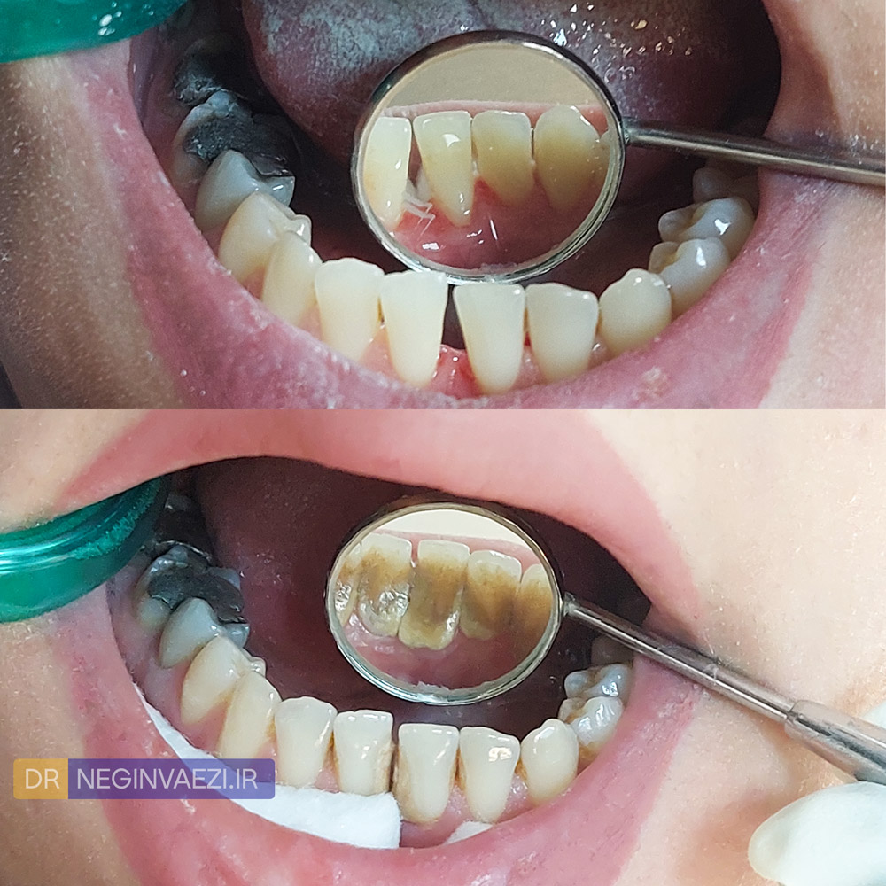 قبل و بعد جرم گیری دندان در تبریز - مراجعه منظم برای جرم‌گیری دندان جهت پیشگیری از بیماری لثه
