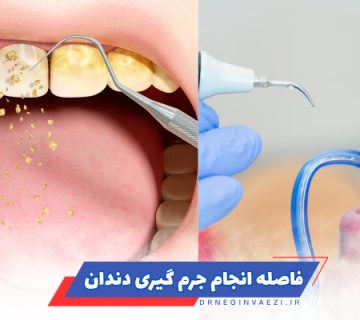 جرم‌گیری دندان چند وقت یکبار و فاصله بین جرم‌گیری دندان‌ها