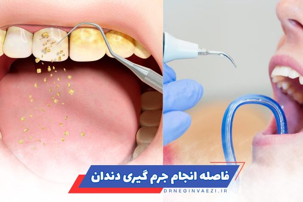 جرم‌گیری دندان چند وقت یکبار و فاصله بین جرم‌گیری دندان‌ها