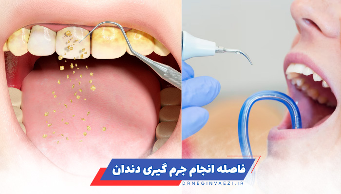 جرمگیری دندان چند وقت یکبار و فاصله بین جرمگیری دندانها