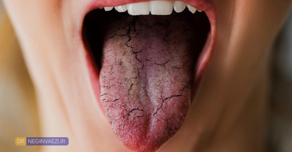 خشکی دهان Xerostomia یکی از عوامل بوی بد دهان بعد از کامپوزیت ونیر و روکش می باشد.