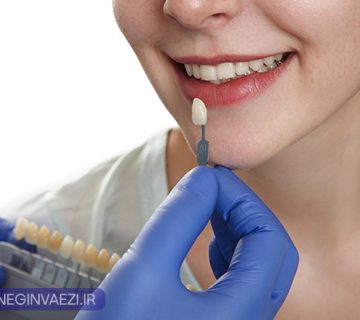 کی نباید کامپوزیت کنیم دندان مناسب برای ونیر کامپوزیت چه کسانی نباید کامپوزیت کنند