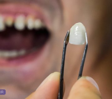 افتادن روکش دندان و راه‌حل‌های درمان و جلوگیری از آن در تبریز