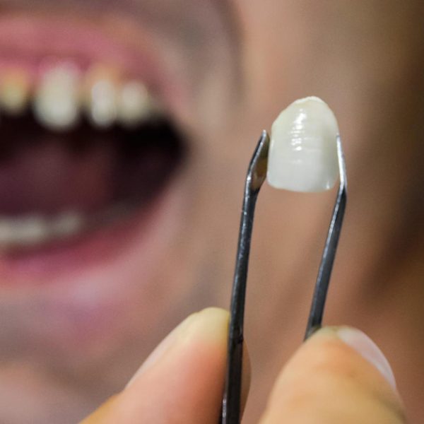 افتادن روکش دندان و راه‌حل‌های درمان و جلوگیری از آن در تبریز