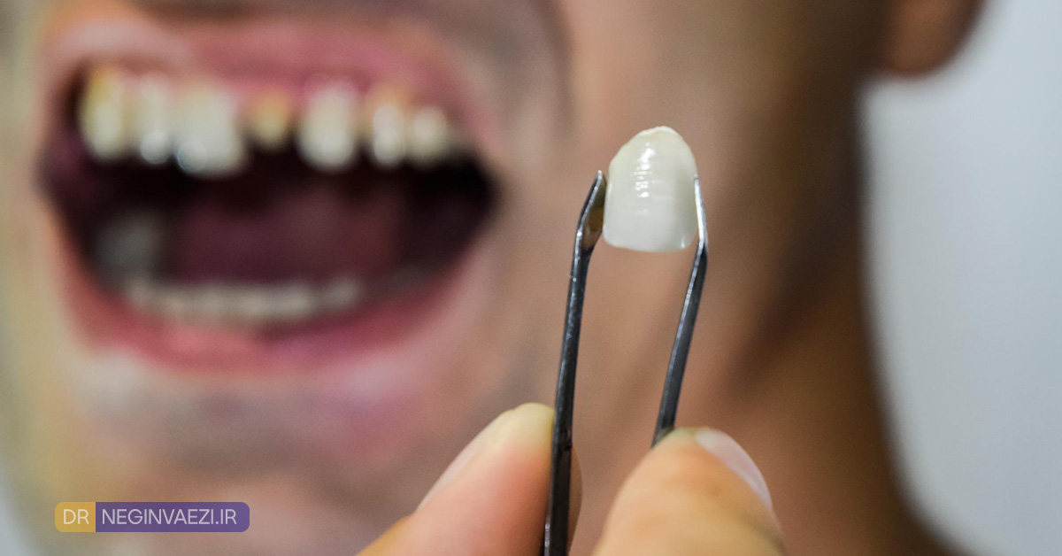 افتادن روکش دندان و راهحلهای درمان و جلوگیری از آن در تبریز