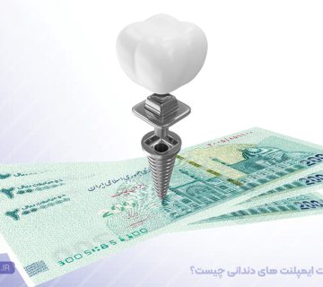 مقایسه برندهای مختلف ایمپلنت دندان از نظر قیمت و کیفیت و تفاوت قیمت ایمپلنت در تبریز