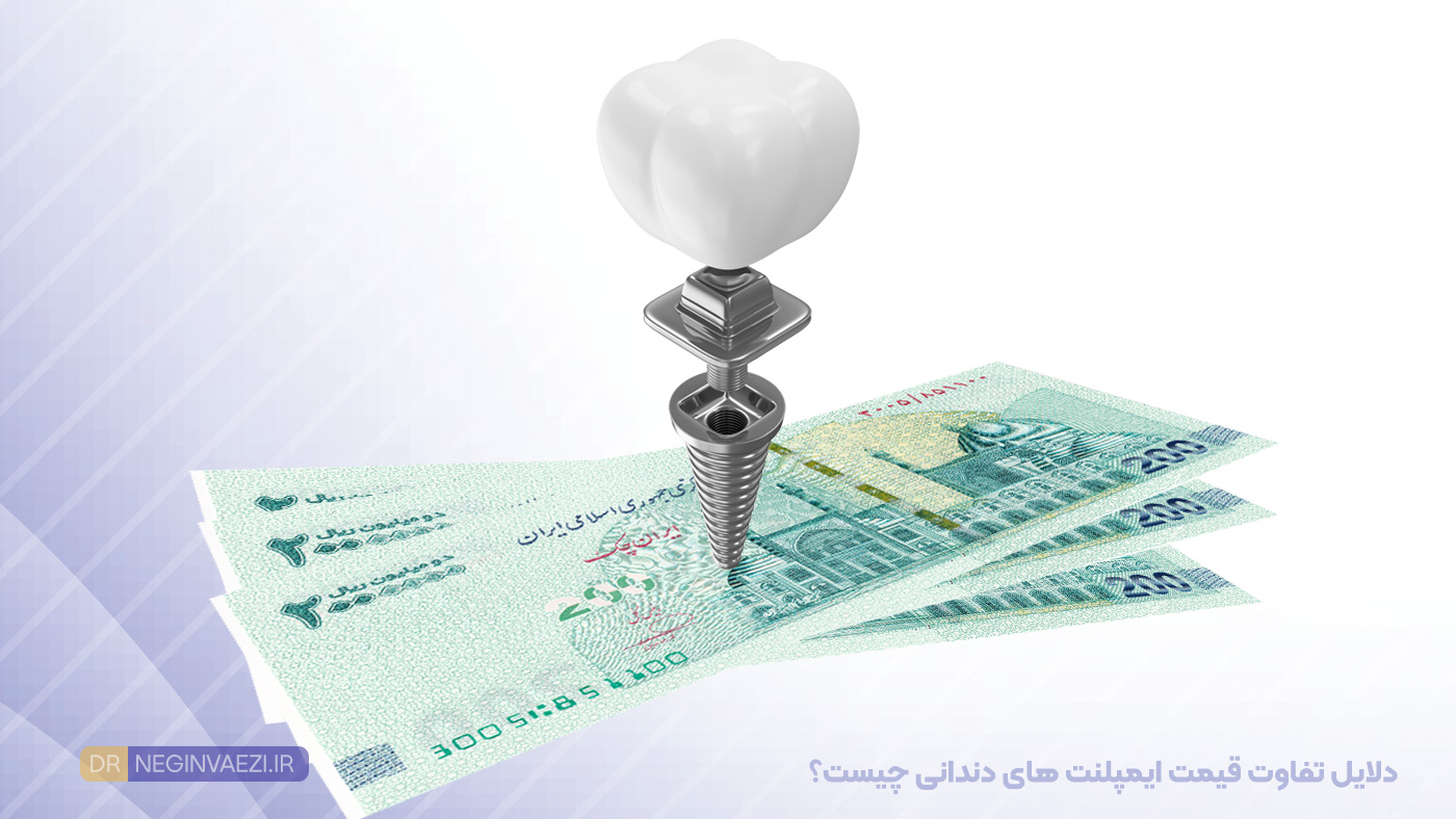 مقایسه برندهای مختلف ایمپلنت دندان از نظر قیمت و کیفیت و تفاوت قیمت ایمپلنت در تبریز