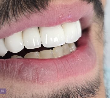 قیمت روکش دندان در تبریز به همراه جدول انواع روکش مانند پی اف ام و سرامیکی زیرکونیا و هزینه ها