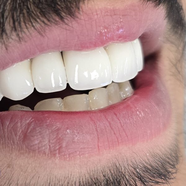 قیمت روکش دندان در تبریز به همراه جدول انواع روکش مانند پی اف ام و سرامیکی زیرکونیا و هزینه ها