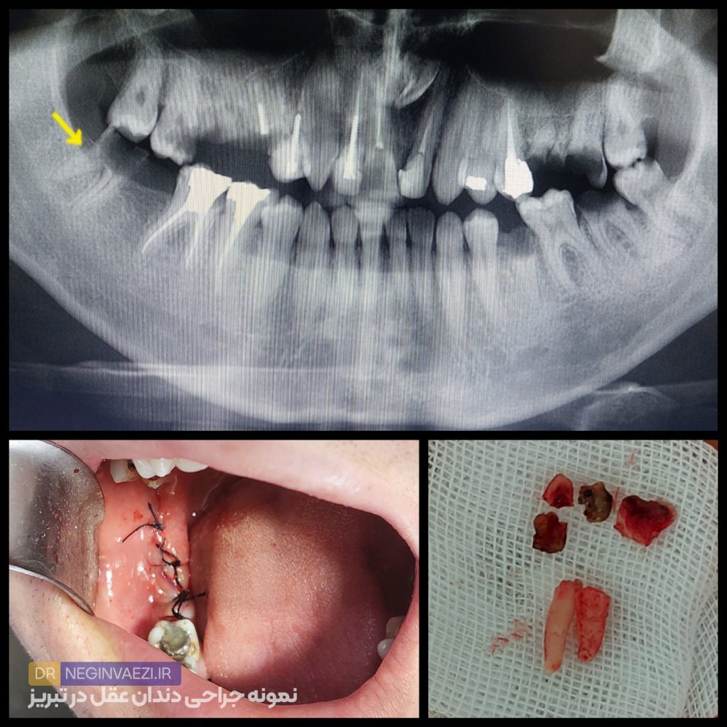نمونه کار جراحی دندان عقل و عقل نیمه نهفته در تبریز توسط دکتر نگین واعظی