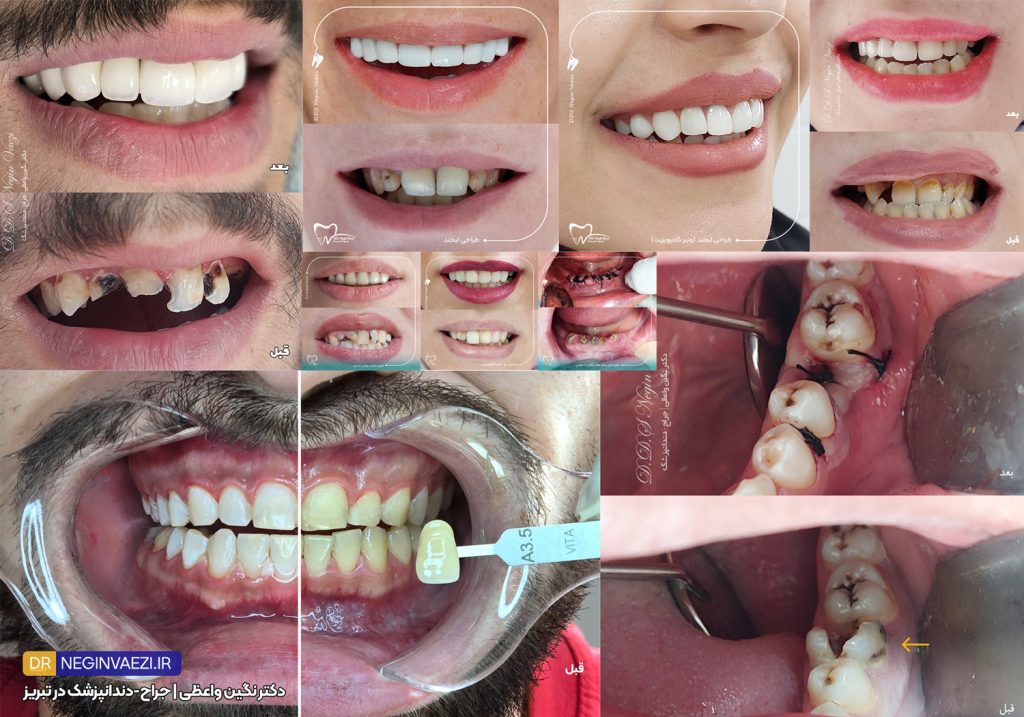 بهترین دندانپزشک خانم در تبریز همراه با نمونه کار دندانپزشک زن در تبریز برای بهترین انتخاب دکتر نگین واعظی