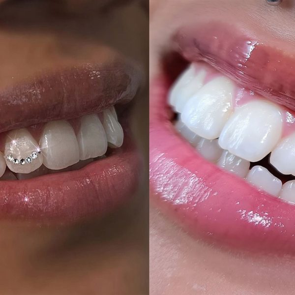 نصب نگین دندان در تبریز روی دندان جلویی توسط دندانپزشک زیبایی دکتر نگین واعظی