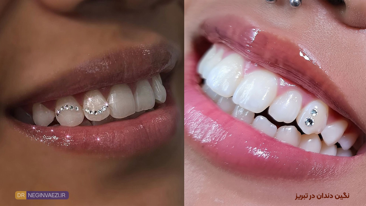 نصب نگین دندان در تبریز روی دندان جلویی توسط دندانپزشک زیبایی دکتر نگین واعظی