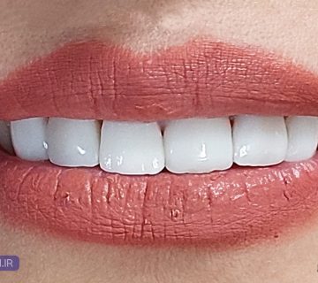 هزینه، تعرفه و قیمت ونیر کامپوزیت دندان در تبریز سال ۱۴۰۴ ولیعصر