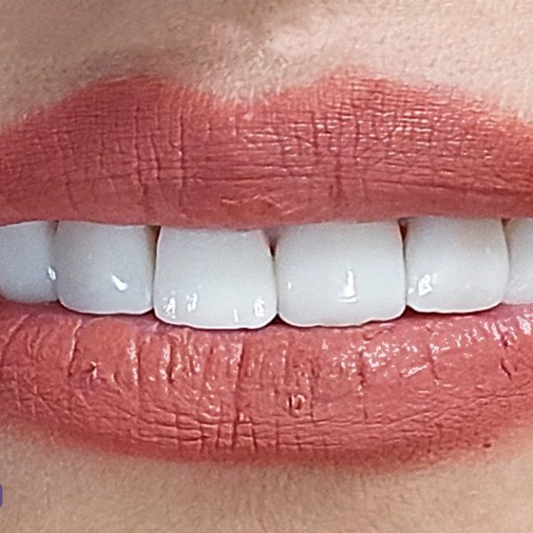 هزینه، تعرفه و قیمت ونیر کامپوزیت دندان در تبریز سال ۱۴۰۴ ولیعصر