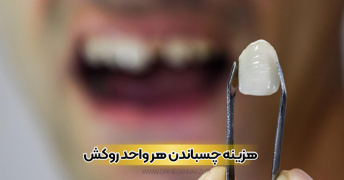 چسباندن مجدد روکش دندان افتاده در تبریز با قیمت مناسب