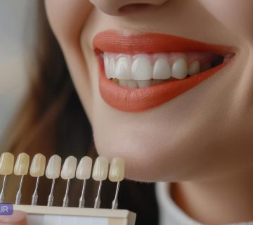 مقایسه کامل لمینیت ونیر سرامیکی و کامپوزیت دندان جلو در تبریز