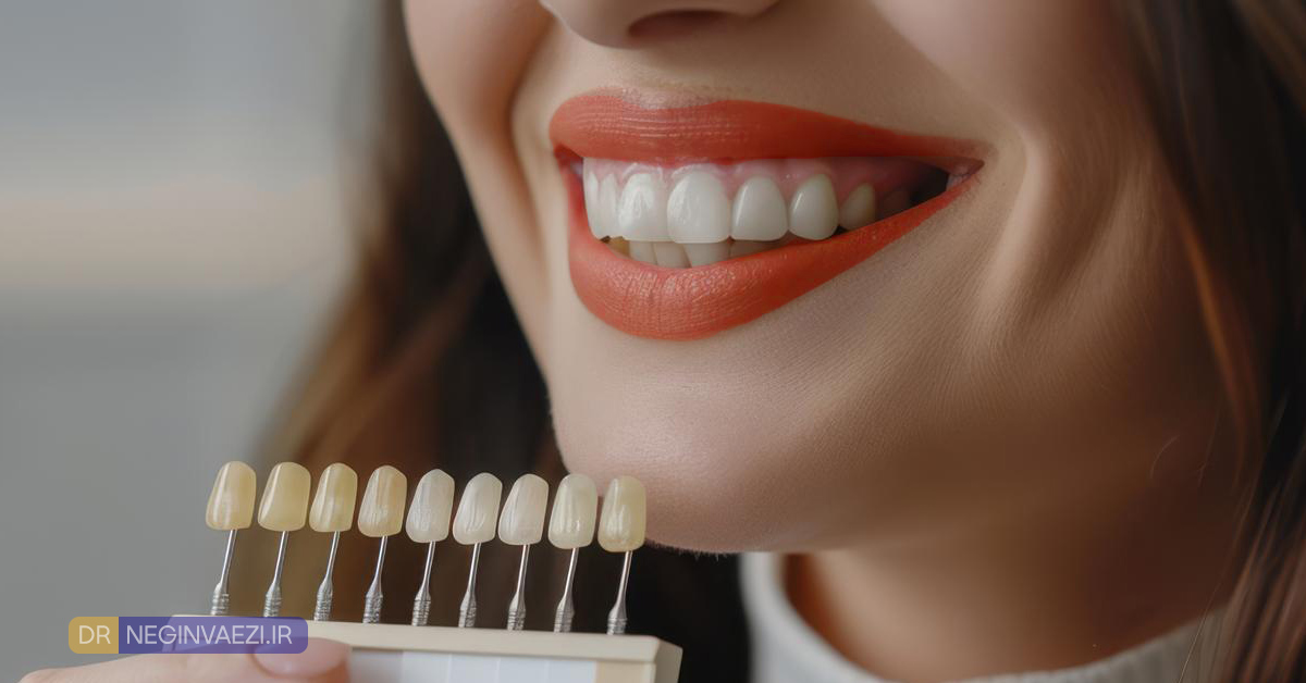 مقایسه کامل لمینیت ونیر سرامیکی و کامپوزیت دندان جلو در تبریز