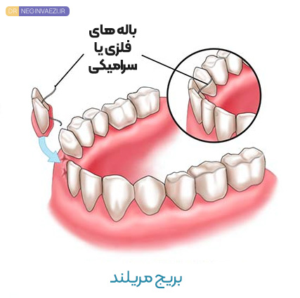 بریج مریلند تبریز