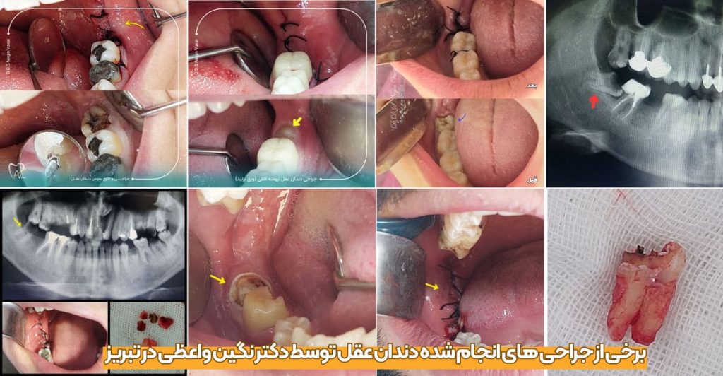 جراحی دندان عقل تبریز دکتر نگین واعظی 1024x532