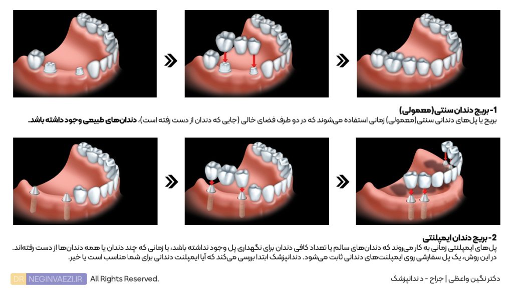 مراحل بریج پل دندان سنتی و بریج ایمپلنت دکتر نگین واعظی 1024x582