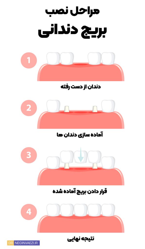 مراحل نصب بریج دندانی 596x1024