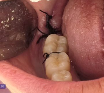 تصویر شماتیک بخیه روی لثه پس از جراحی دندان عقل توسط دکتر نگین واعظی در تبریز