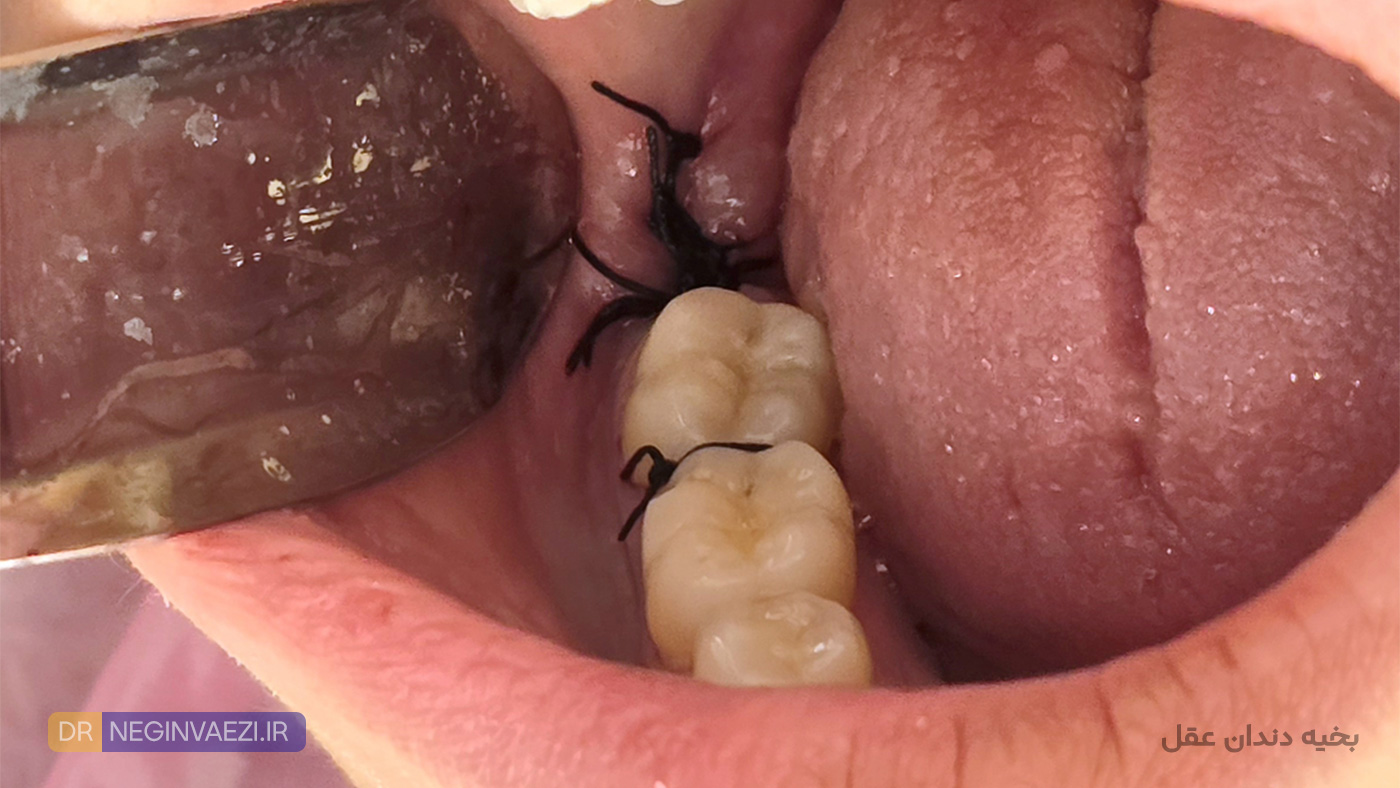 تصویر شماتیک بخیه روی لثه پس از جراحی دندان عقل توسط دکتر نگین واعظی در تبریز