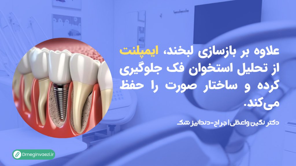 ایمپلنت دندان در تبریز بازسازی لبخند و جلوگیری از تحلیل استخوان فک را تضمین می کند