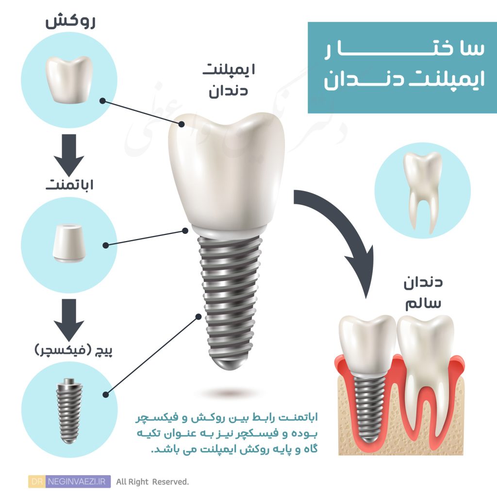 تصویر شماتیک ساختار ایمپلنت دندان - مزایا و معایب ایمپلنت دندان در تبریز - دکتر نگین واعظی