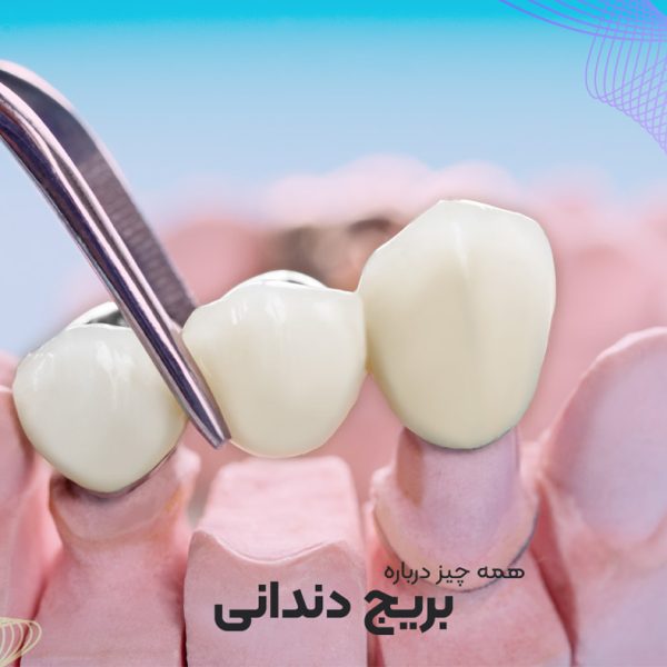 بریج دندان در تبریز یا پل دندانی در مطب دکتر نگین واعظی