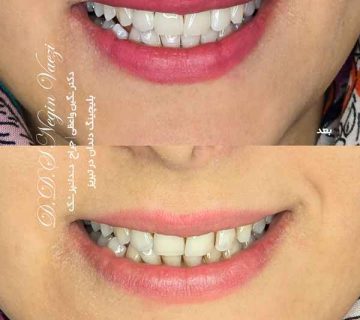 عکس قبل و بعد بلیچینگ دندان در تبریز توسط دکتر نگین واعظی ولیعصر سفید کردن فوری دندان