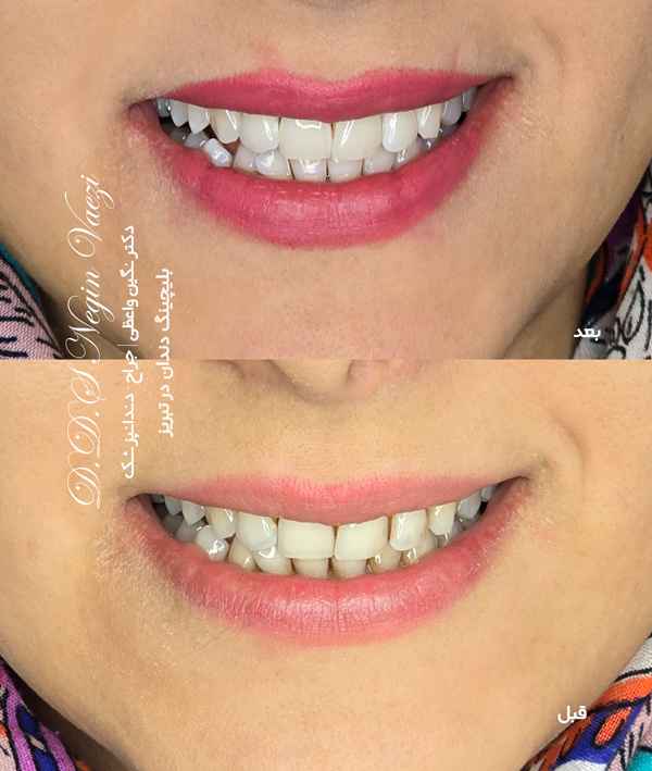عکس قبل و بعد بلیچینگ دندان در تبریز توسط دکتر نگین واعظی ولیعصر سفید کردن فوری دندان