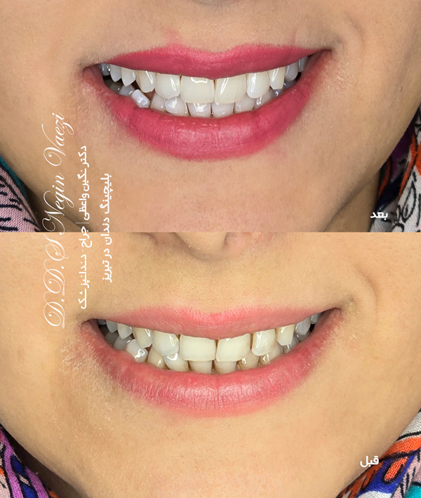 عکس قبل و بعد بلیچینگ دندان در تبریز و نمونه کار بلیچینگ دندان تبریز توسط دکتر نگین واعظی ولیعصر