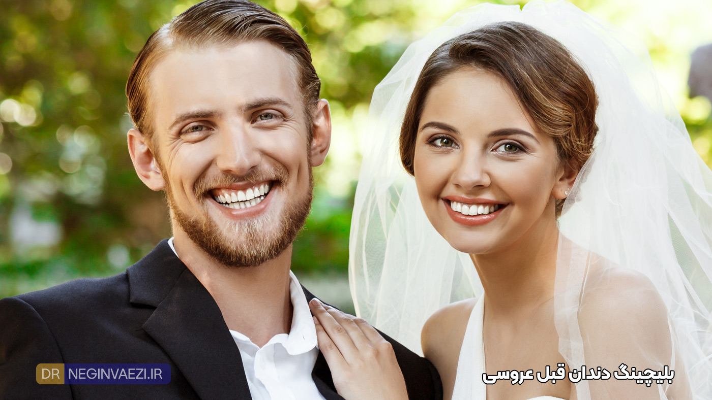 بلیچینگ دندان قبل از عروسی در تبریز و تصویر لبخند عروس و داماد بعد از بلیچینگ در تبریز