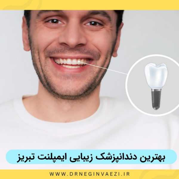 بهترین دندانپزشک زیبایی ایمپلنت تبریز دکتر نگین واعظی و معرفی بهترین روکش های ایمپلنت