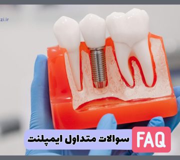 پاسخ به سوالات متداول بیماران درباره ایمپلنت دندان توسط دکتر نگین واعظی جراح دندانپزشک در تبریز