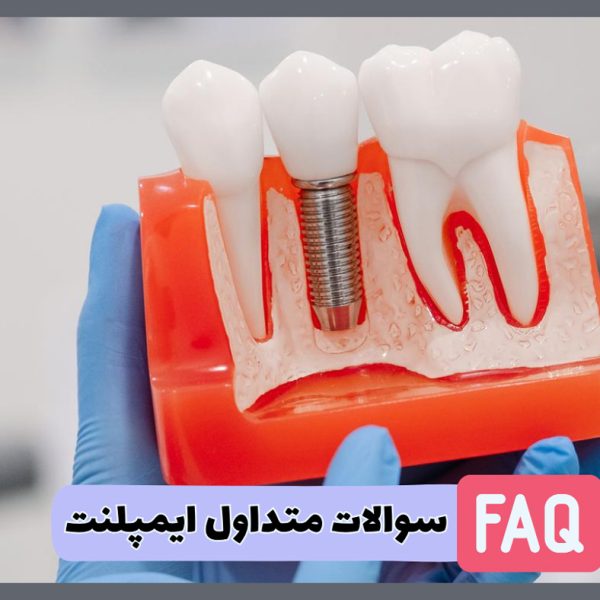 پاسخ به سوالات متداول بیماران درباره ایمپلنت دندان توسط دکتر نگین واعظی جراح دندانپزشک در تبریز