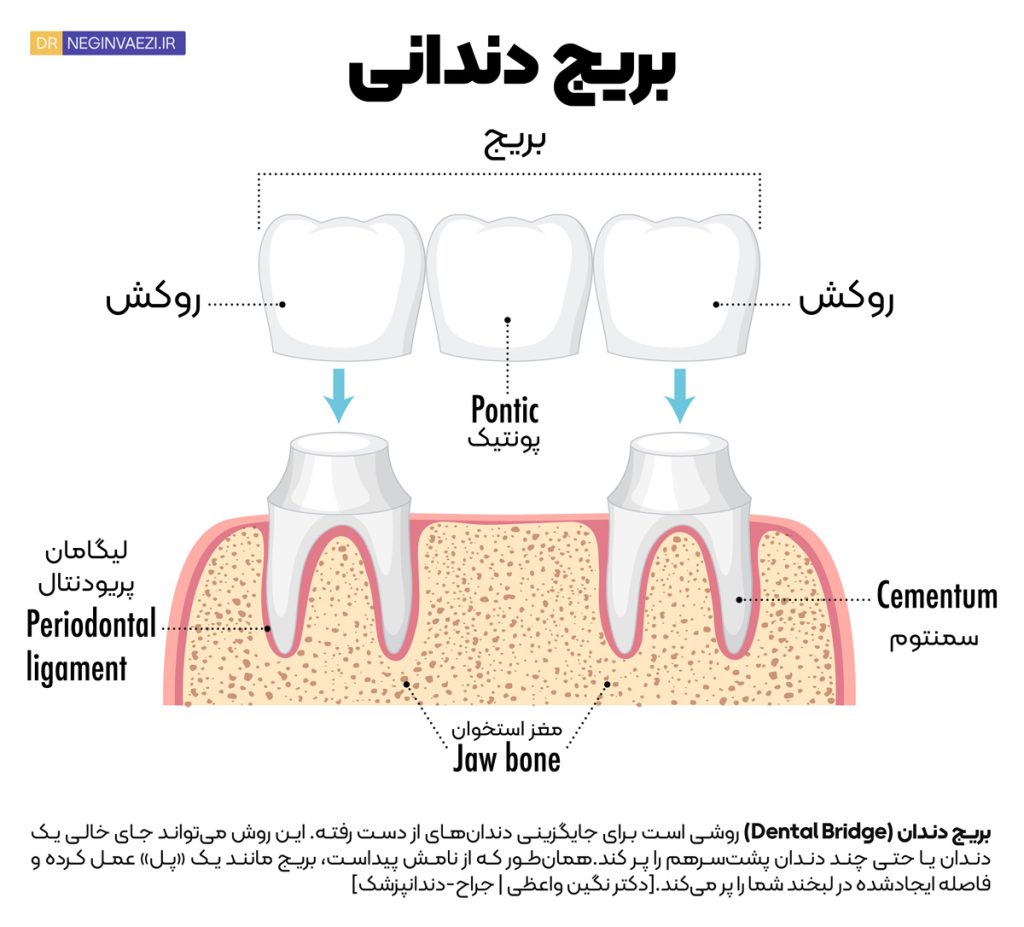 بخش ها و اجزای اصلی بریج دندانی شامل پونتیک و اباتمنت - دکتر نگین واعظی تبریز