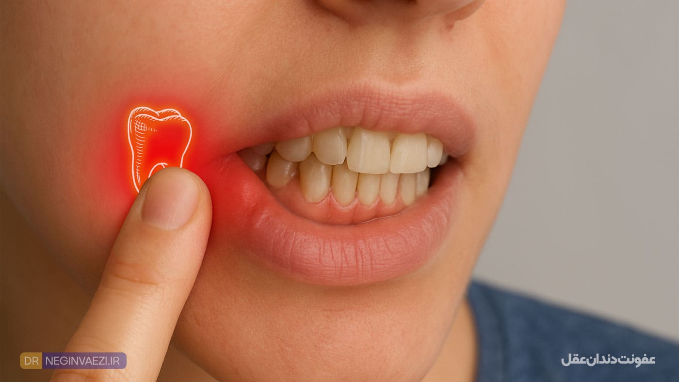 عفونت دندان عقل و درمان و جراحی دندان عقل در تبریز توسط دکتر نگین واعظی در مطب ولیعصر