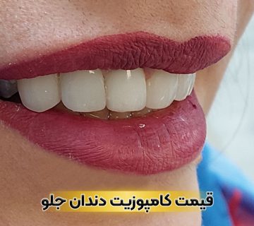 هزینه و قیمت کامپوزیت دندان جلو در تبریز - ونیر کامپوزیتی برای هر واحد دندان در مطب دکتر نگین واعظی