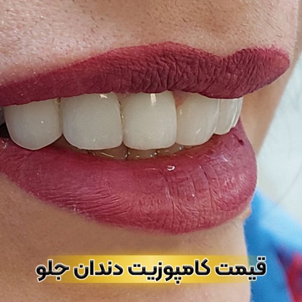 هزینه و قیمت کامپوزیت دندان جلو در تبریز - ونیر کامپوزیتی برای هر واحد دندان در مطب دکتر نگین واعظی
